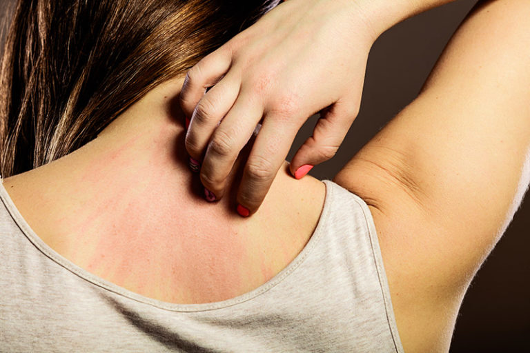 Laundry Detergent Rash: How to Treat and Prevent It